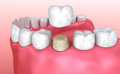 Dental Crowns And Bridges At Your Dentist